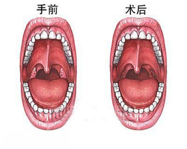 扁桃腺切除术